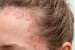Psoriasis-treatment-in-Banaglore-10