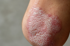 Psoriasis-treatment-in-Banaglore-14