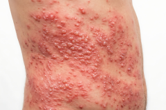 Psoriasis-treatment-in-Banaglore-16