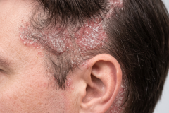 Psoriasis-treatment-in-Banaglore-17