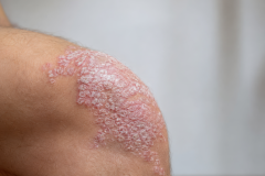 Psoriasis-treatment-in-Banaglore-18