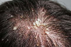 Psoriasis-treatment-in-Banaglore-19