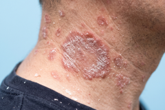 Psoriasis-treatment-in-Banaglore-2