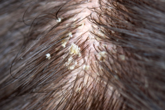 Psoriasis-treatment-in-Banaglore-22