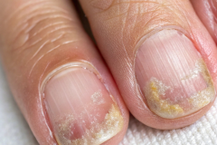 Psoriasis-treatment-in-Banaglore-23
