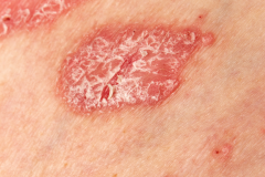 Psoriasis-treatment-in-Banaglore-25