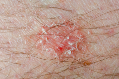 Psoriasis-treatment-in-Banaglore-26