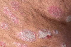 Psoriasis-treatment-in-Banaglore-27