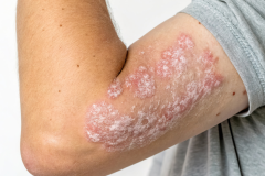 Psoriasis-treatment-in-Banaglore-28