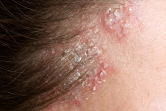Psoriasis-treatment-in-Banaglore-3