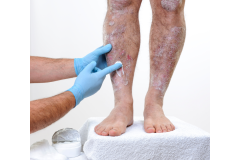 Psoriasis-treatment-in-Banaglore-30