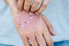 Psoriasis-treatment-in-Banaglore-31