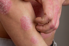 Psoriasis-treatment-in-Banaglore-32
