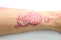Psoriasis-treatment-in-Banaglore-34