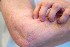 Psoriasis-treatment-in-Banaglore-35