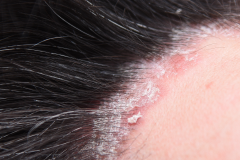 Psoriasis-treatment-in-Banaglore-36