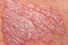 Psoriasis-treatment-in-Banaglore-37