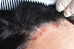 Psoriasis-treatment-in-Banaglore-38
