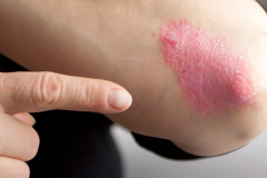 Psoriasis-treatment-in-Banaglore-39