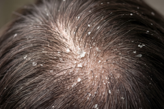 Psoriasis-treatment-in-Banaglore-4