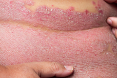 Psoriasis-treatment-in-Banaglore-40