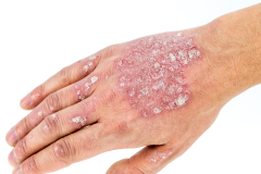 Psoriasis-treatment-in-Banaglore-41