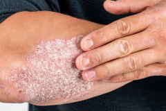 Psoriasis-treatment-in-Banaglore-42