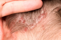 Psoriasis-treatment-in-Banaglore-43