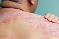 Psoriasis-treatment-in-Banaglore-44