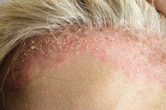 Psoriasis-treatment-in-Banaglore-45