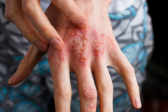 Psoriasis-treatment-in-Banaglore-46