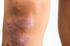 Psoriasis-treatment-in-Banaglore-47