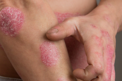 Psoriasis-treatment-in-Banaglore-48