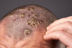 Psoriasis-treatment-in-Banaglore-49