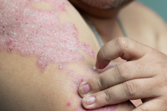 Psoriasis-treatment-in-Banaglore-50