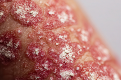Psoriasis-treatment-in-Banaglore-6