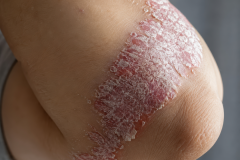 Psoriasis-treatment-in-Banaglore-7