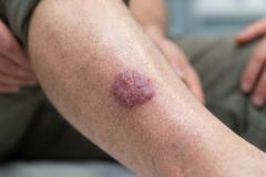 Psoriasis-treatment-in-Banaglore-8