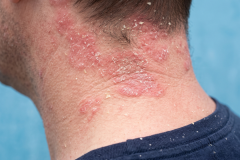 Psoriasis-treatment-in-Banaglore-9
