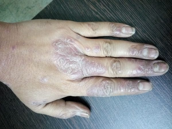 Nail Psoriasis image