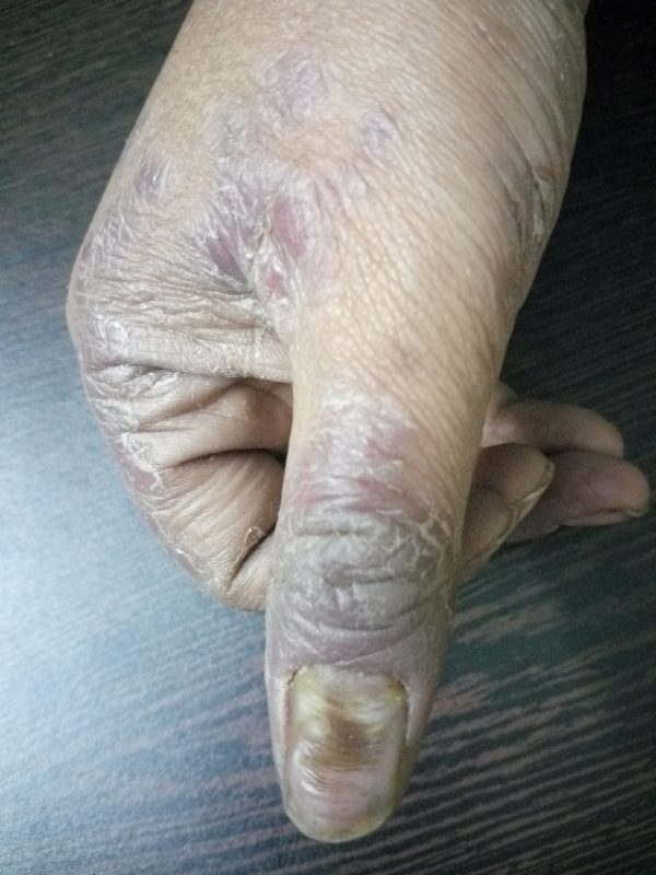 Nail Psoriasis image