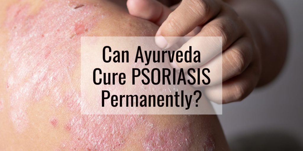 Can Ayurveda Cure Psoriasis Permanently