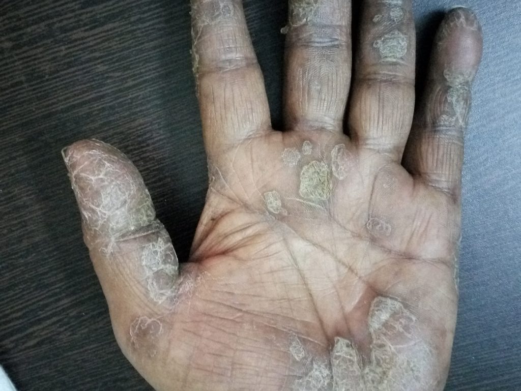 Complete Cure of Palmar Psoriasis