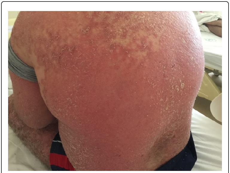 एरिथ्रोडर्मिक-सोरायसिस-erythrodermic-psoriasis