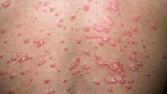 गटेट-सोरायसिस-Guttate-Psoriasis