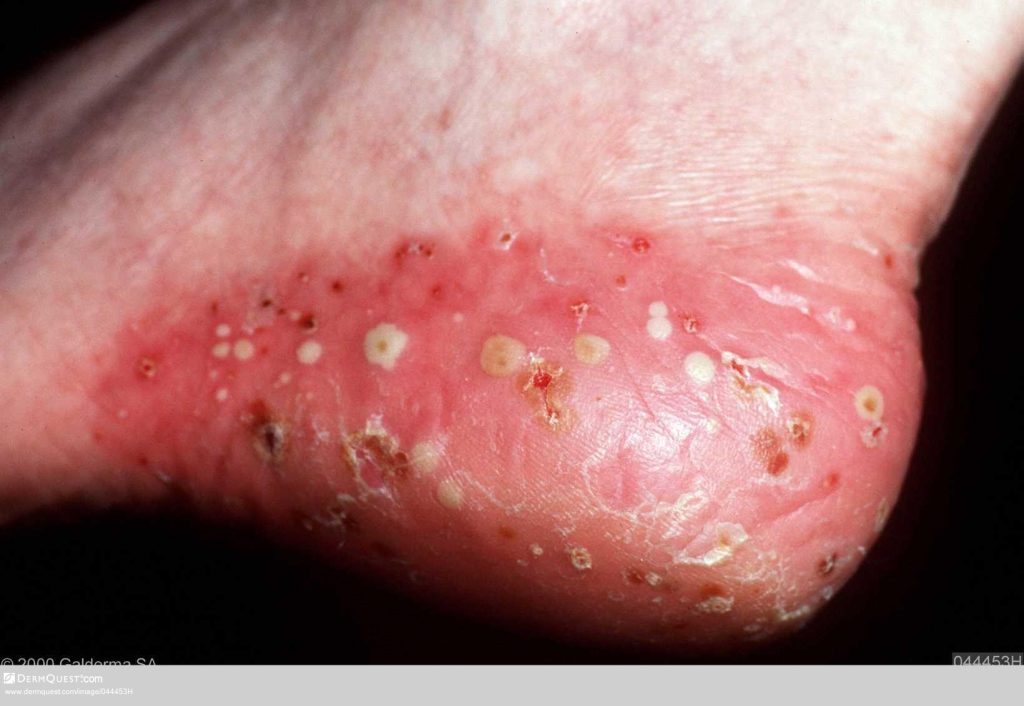 पस्टुलर-सोरायसिस-Pustular-Psoriasis