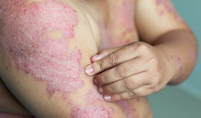 प्लाक सोरायसिस - Plaque Psoriasis