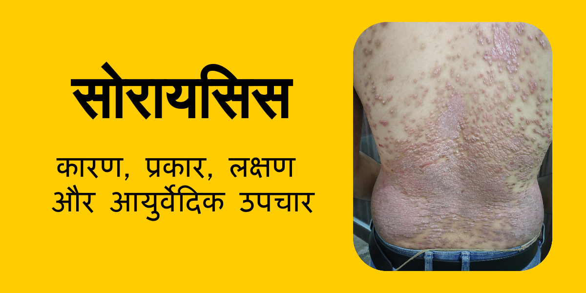 सोरायसिस (Psoriasis Meaning in Hindi)