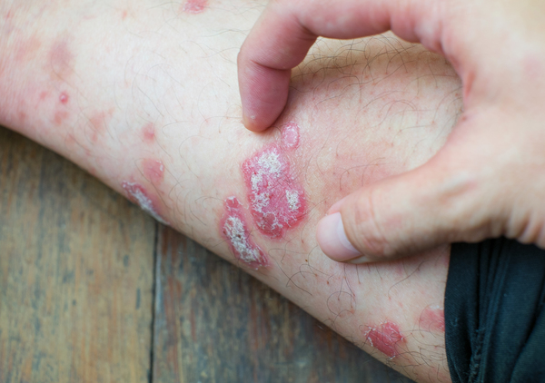 Symptoms of psoriasis in hindi
