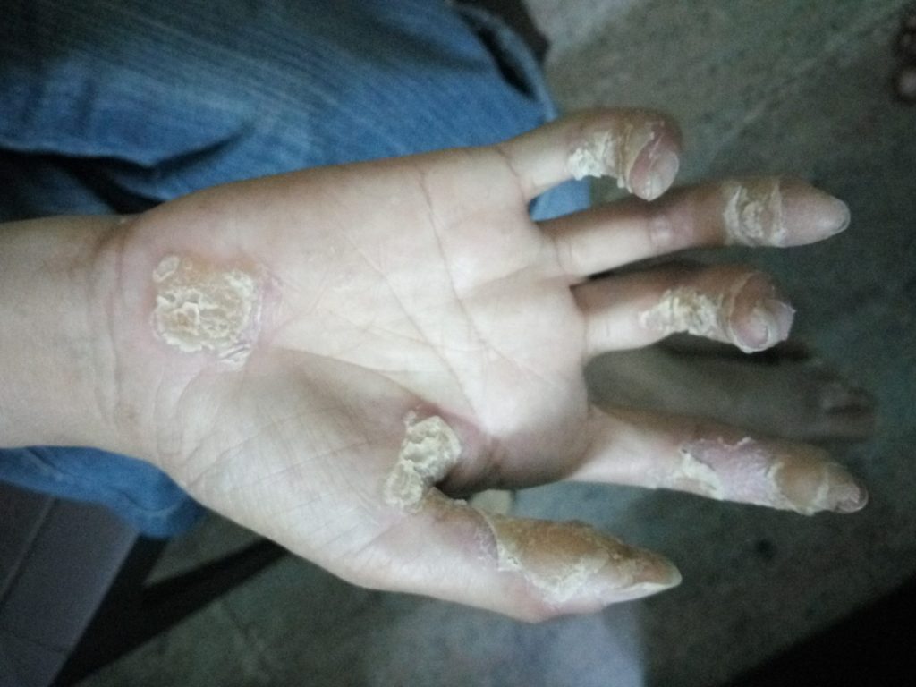 Palmar Psoriasis